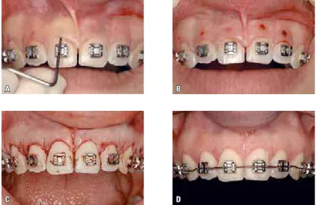 FIGURA 25 - A, B) Sondagem periodontal durante a fase de finalização do tratamento. C) Gengivecto- Gengivecto-mia realizada na arcada superior