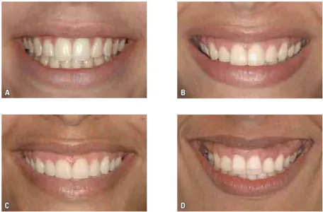 FIGURA 1 - Diferentes graus de exposição gengival ao sorrir: A) 0mm; B) 1mm; C) 2mm e D) 4mm.