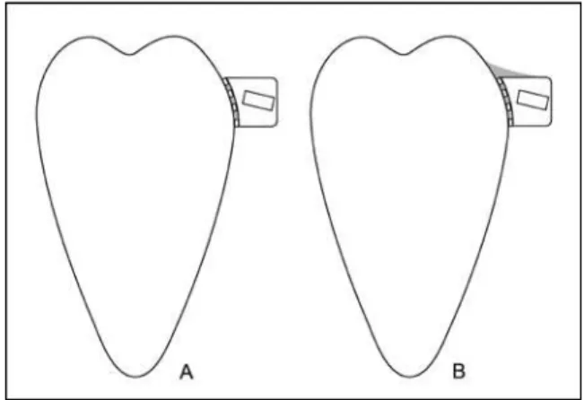 FIGURA  7  -  A)  colagem  direta  convencional;  B)  aumento  da  área  da  resina a fim de aumentar a resistência adesiva do conjunto  tubo/re-sina/dente.