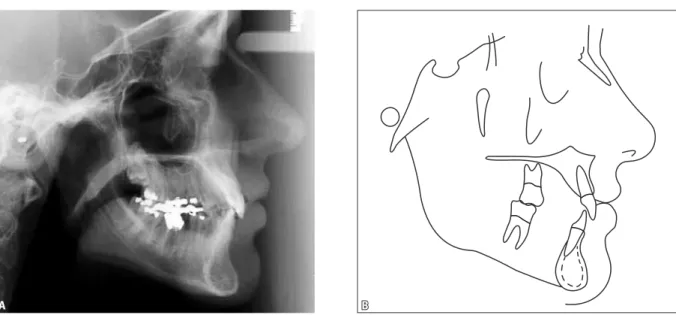 FIGURA 4 - Radiografia cefalométrica de perfil (A) e traçado cefalométrico (B) iniciais.
