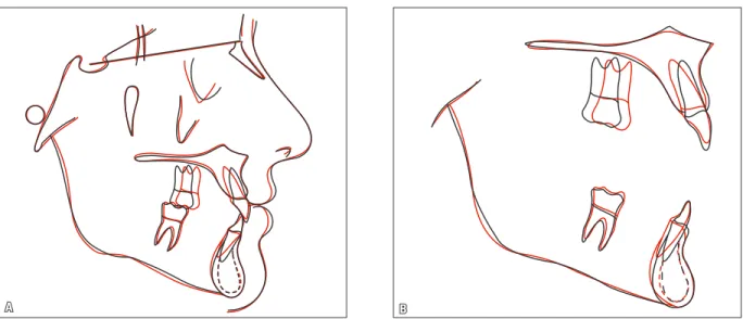 FIGURA 10 - Fotografias faciais e intrabucais de controle, quatro anos e cinco meses após o término do tratamento.FIGURA 9 - Sobreposições total (A) e parciais (B) dos traçados cefalométricos inicial (preto) e final (vermelho).