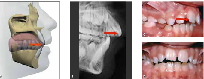 FIGURA 8 - Esquema (A), radiografia (B) e fotografias (C e D) de postura horizontal de língua em repouso, associada a uma mordida aberta moderada,  podendo apresentar trespasse vertical