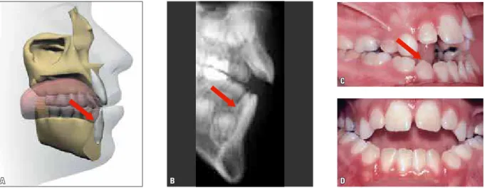FIGURA 10 - Esquema (A), radiografia (B) e fotografias (C e D) de postura muito baixa de língua em repouso, associada a uma mordida aberta severa