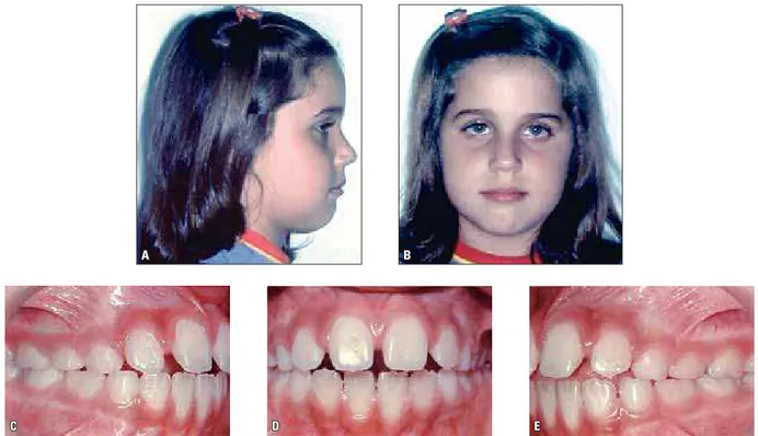 FIGURA 11 - Fotografias faciais (A e B) e intrabucais (C, D e E) iniciais.