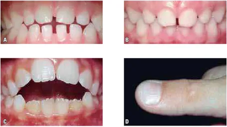 FIGURA 2 - A) MAA na dentição decídua causada por sucção de chupeta e B) correção espontânea  após a remoção do hábito