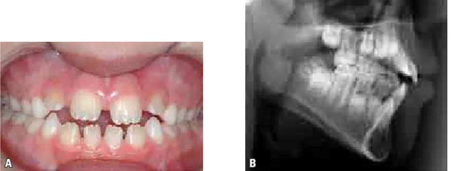 FIGURA 3 - MAA causada por postura baixa da língua em repouso e interposição labial (A)