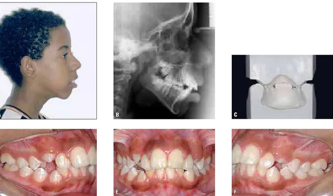 FIGURA 4 - Fotografia de perfil (A), radiografia cefalométrica (B), modelos de gesso (C) e fotografias intrabucais (D, E e F) de paciente portador de padrão  facial hiperdivergente (SNGoGn=49º), apresentando sobremordida exagerada, que pode ser notada mais