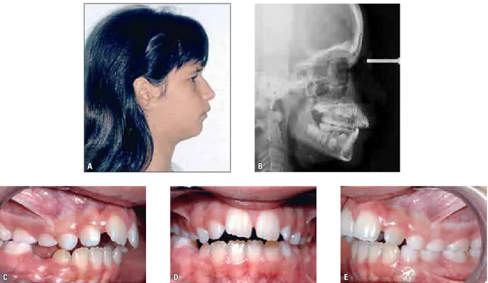 FIGURA 5 - Fotografia de perfil (A), radiografia cefalométrica (B) e fotografias intrabucais (C,  D e E) de paciente portadora de padrão facial normal  (SNGoGn=34º), apresentando MAA