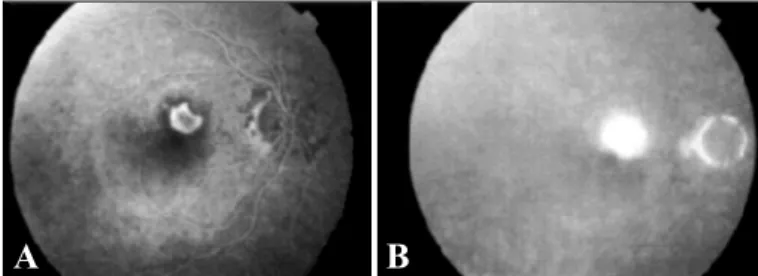 Figura 10 - Paciente com DMRI e MNSR hemorrágica. A) Angiofluores- Angiofluores-ceinografia: Note bloqueio total da MNSR; B) Videoangiografia Digital