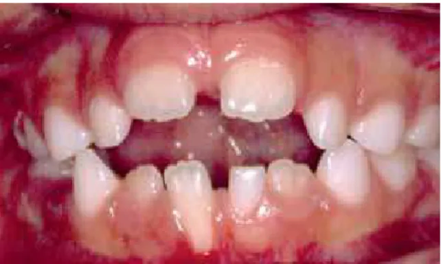 FIGURA 2 - Paciente adulto jovem com dentes mal posicionados e gen- gen-givite hiperplásica.
