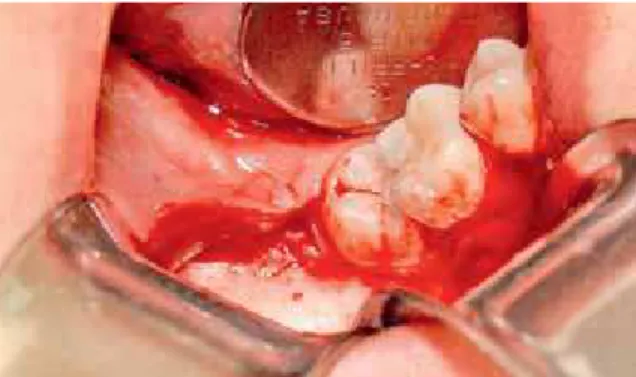 FIGURA 1 - Radiografia panorâmica inicial mostrando o dente 47 com  impacção mesial.