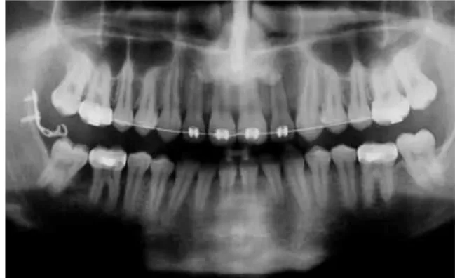 FIGURA 8 - Radiografia panorâmica mostrando o dente 47 na posição  correta após 3 meses de tratamento.