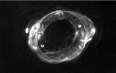 Figure 2 - IOL photograph inside the capsular bag after surgical removal. Note capsular contraction with a curved prolene haptic lens