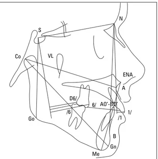 FIGURA 3 - Construção da análise cefalométrica: medidas angulares.  SNA: ângulo Sela-Násio-Ponto A; SNB: ângulo Sela-Násio-Ponto B;  SND: ângulo Sela-Násio-Ponto D; ANB: ângulo Ponto A-Ponto B; NA/ APog: ângulo formado pelo Násio-Ponto A e Pogônio-Ponto A;