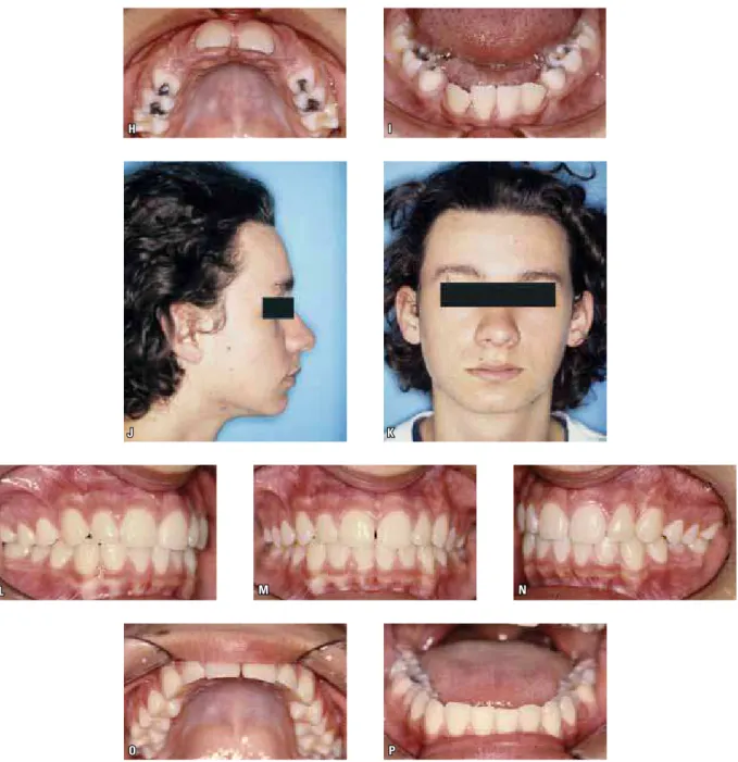 FIGURA 2 - Paciente selecionado do grupo amostral, no qual o programa de extrações seriadas chegou apenas à fase reversível, ou seja, extração de  dentes decíduos