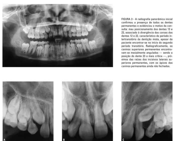 FIGURA 4 - Uma técnica de deslocamento horizontal do tubo (técnica de Clark) 10  com radiografias periapicais confirmou que o canino superior esquerdo 