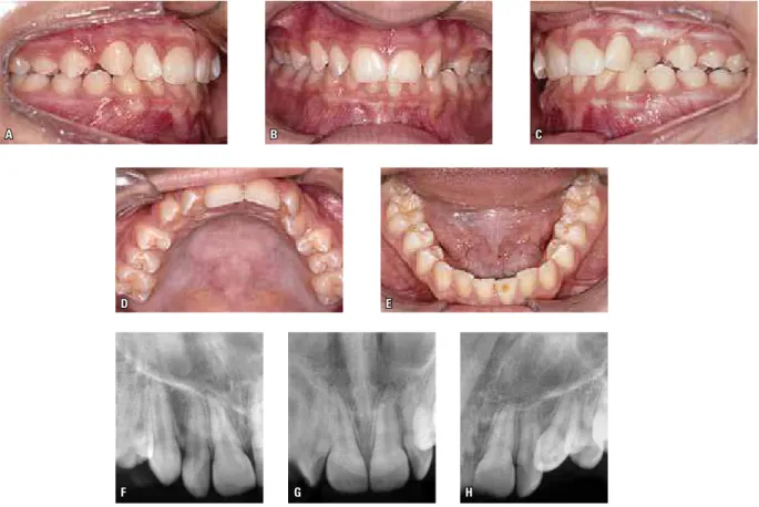 FIGURA 11 - A nova documentação ortodôntica (A-E), com a paciente aos dez anos e nove meses de idade, confirmou a boa evolução do tratamento intercep- intercep-tativo para correção da trajetória eruptiva dos dentes 13 e, especialmente, do dente 23