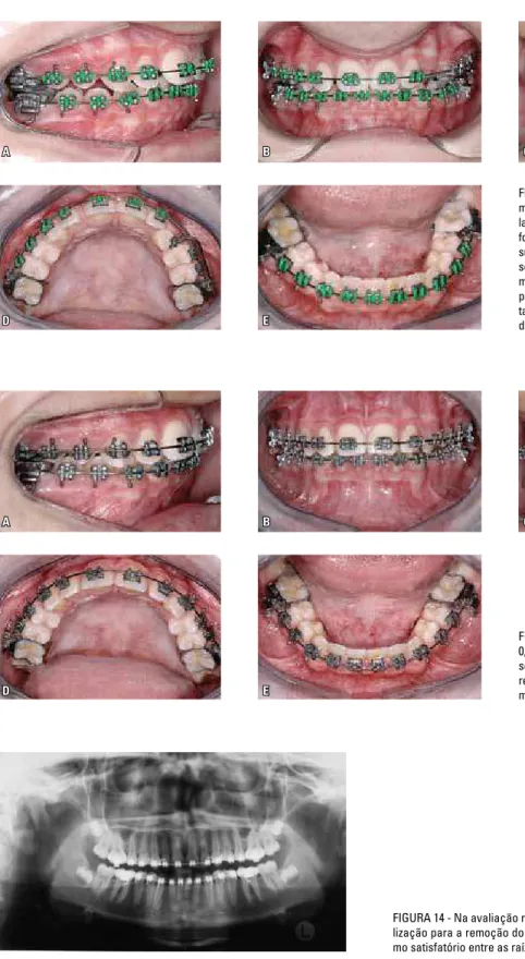 FIGURA 13 - Na fase de arcos de nivelamento  0,020” de aço superior e inferior (A-E), dez  me-ses após o início do tratamento ortodôntico  cor-retivo, o dente 23 já se encontrava  completa-mente descruzado, em posição de normalidade.