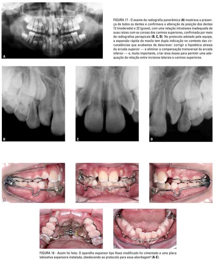 FIGURA 18 - Assim foi feito. O aparelho expansor tipo Haas modificado foi cimentado e uma placa  labioativa expansora instalada, obedecendo ao protocolo para essa abordagem 6  (A-E).