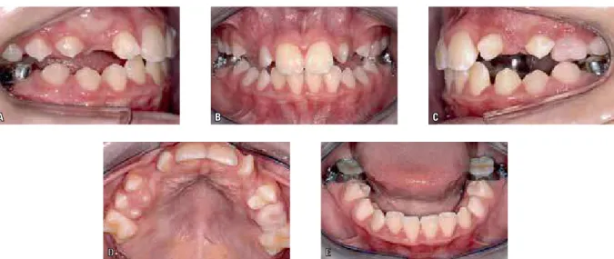 FIGURA 23 - A cirurgia foi realizada, obedecendo de modo rígido o protocolo apresentado como item principal desse artigo