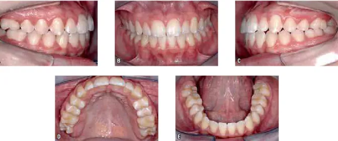 FIGURA 30 - O produto final: uma oclusão com muita qualidade e construída por um tratamento ortodôntico simples e convencional