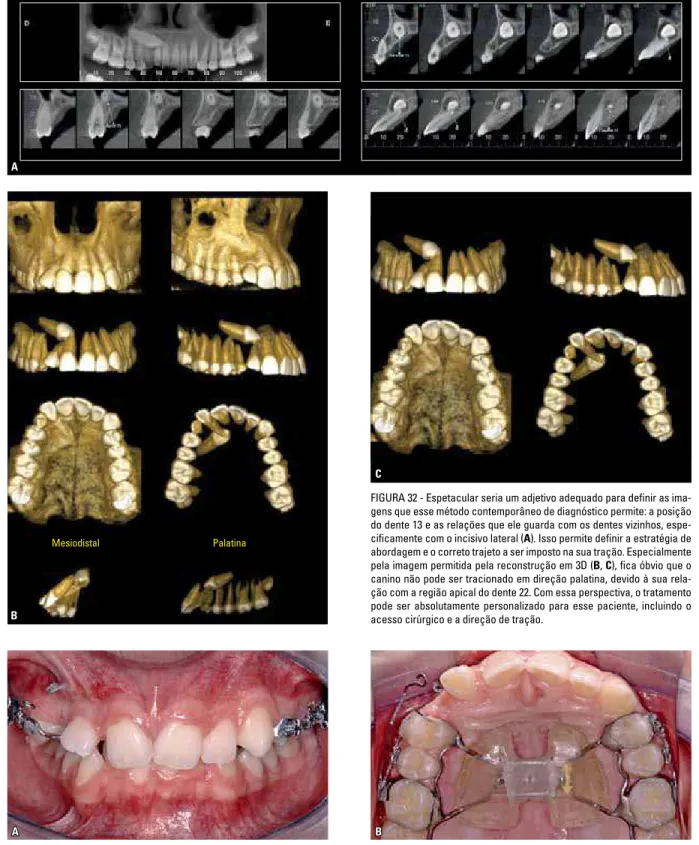 FIGURA 33 - A expansão rápida da maxila, graças à oportunidade que oferece para disponibilizar osso na região anterior da maxila, é quase regra para o tra- tra-tamento dos caninos impactados em pacientes jovens