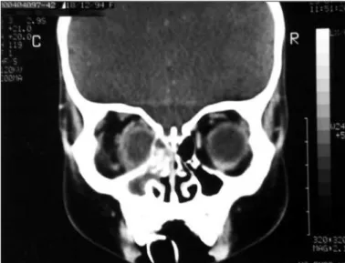 Figure 4 - Coronal scan of computed tomography of the orbit showing a diffuse cellulitis in right orbit