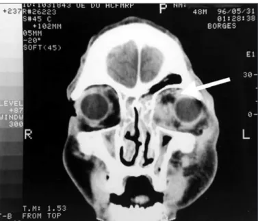 Figure 7 - Coronal scan of computed tomography of the orbit showing a left orbital abscess