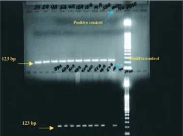 Figure 2 - PCR 150 basis pairs (bp) of L1 gene of HPV samples of pterygium.