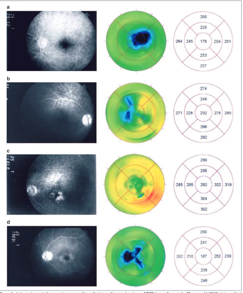 Figure 1 - Late angiogram’s frame and corresponding retinal map diagram. Level zero ACME (group I) - a: male, 58 years old, 20/40 vision, retinal thickness at the fovea: 176 µm; b: male, 51 years old, 20/20 vision, retinal thickness at the fovea: 232 µm