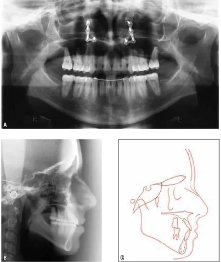 FIGURA 9 - A) Radiografia panorâmica final, B) telerradiografia lateral final, C) traçado cefalométrico final.