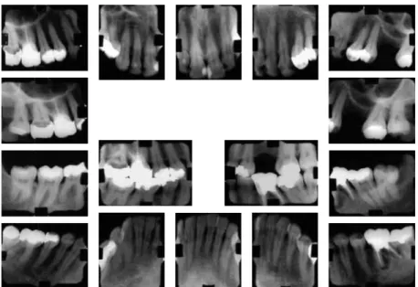 FIGURA 3 - Radiografia cefalométrica de perfil (A) e traçado cefalométrico (B) iniciais.