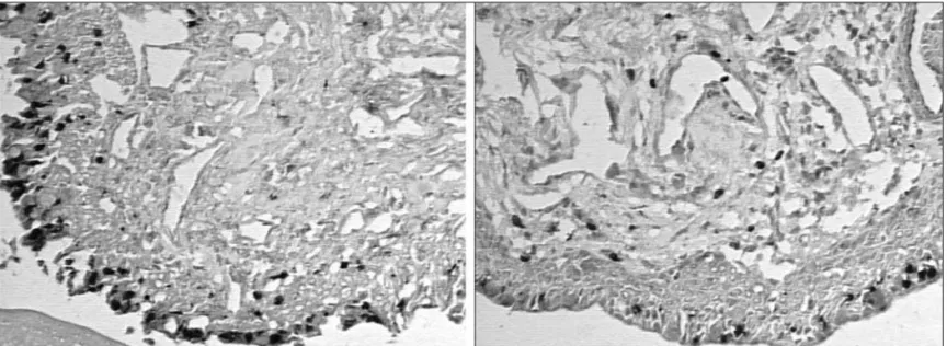 Figure 1 - MMP-9 expression in the pterygium lesion (left) and normal conjunctival tissue (right)