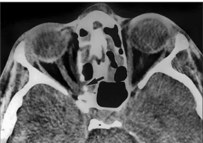 Figure 1 - Computerized tomography scan showing fractures of the left medial orbital wall near the optic canal (arrow)