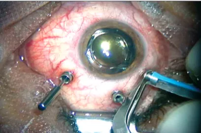 Figure 2 - Silicone oil injected through the second infusion line connected to the microcanula; another microcannula is used for infusion lineFigure 1 - Silicone oil injected through the infusion line