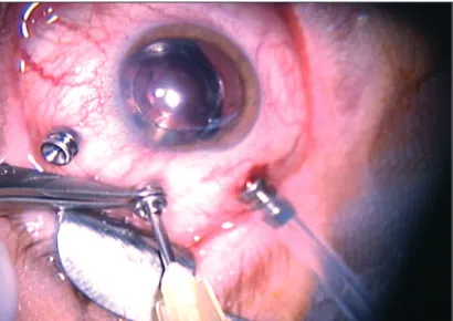 Figure 4 - Bipolar cautery in the conjunctiva over the wound, prevent the