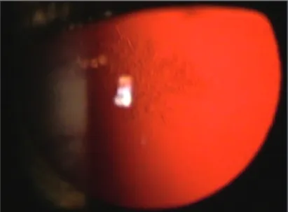Figure 2 - Right eye: complete regression of the cataract two weeks after the first visit
