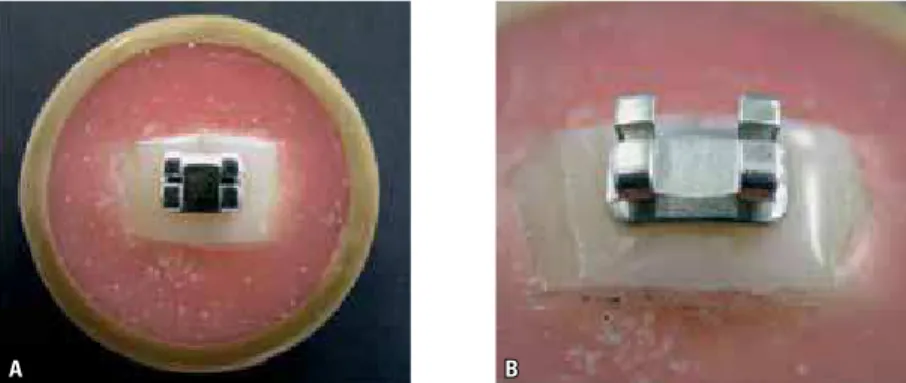 FIGURA 2 - Aspecto dos braquetes colados na região central da coroa. Vista superior (A) e vista infe- infe-rior aproximada (B)