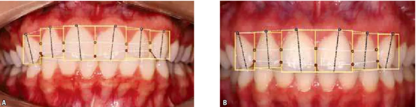 FIGURA 14 - “CHECK LIST” – Linha cervical: côncava (acentuada) e assimétrica. Linha incisal: forma de “prato fundo” invertido (côncava) e assimétrica