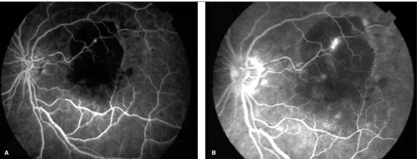 Figure 1A and B - Fluorescein angiography of the affected eye. Observe the increased fluorescence of the retinal arterial macroaneurysm
