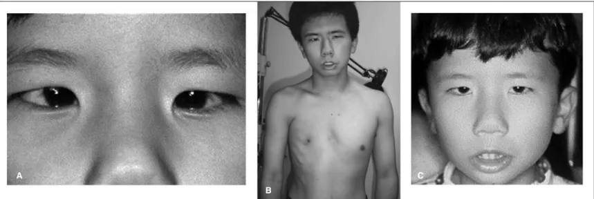 Figure 1 - Patient with Möbius sequence with Poland anomaly (B); he had a very large angle esotropia and a recession of both medial rectus muscles did not change the eyes’ positions, a lateral transposition of the vertical rectus muscles was necessary in o