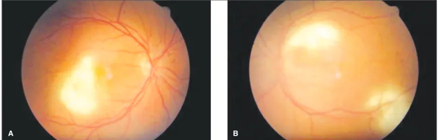 Figure 1 - A e B: Retinitis in posterior poles of both eyes