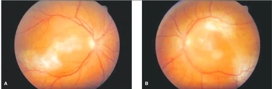 Figure 3 - A e B: After treatment the lesions were healing