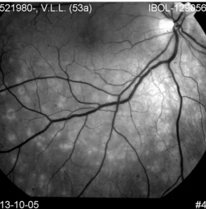Figure 5 - Multiple evanescent white dot syndrome (MEWDS). Red-free photograph showing small, deep, white-dots involving the posterior pole but sparing the fovea