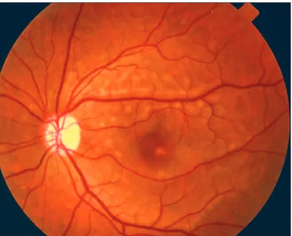 Figure 7 - Inactive multifocal choroiditis and panuveitis. Multiple, round, pigmented lesions with subretinal fibrosis in the macular 