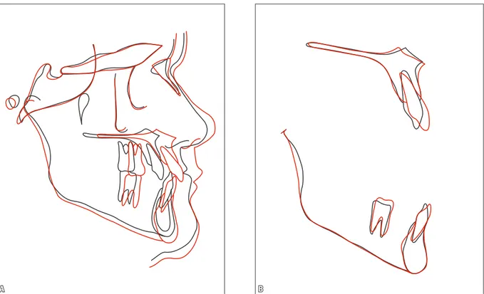FIGURA 14 - Sobreposições total (A) e parciais (B) dos traçados cefalométricos inicial (preto) e final (vermelho).