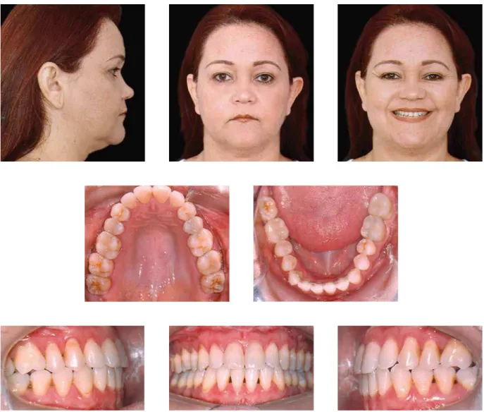 FIGURA 15 - Fotografias faciais e intrabucais de controle quatro anos após o término do tratamento.