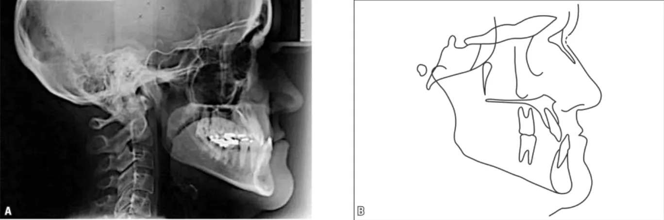FIGURA 4 - Radiografia cefalométrica de perfil (A) e traçado cefalométrico (B) iniciais.FIGURA 3 - Radiografia panorâmica inicial.