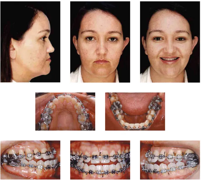 FIGURA 5 - Fotografias faciais e intrabucais pré-cirúrgicas.