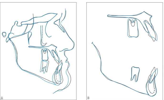 FIGURA 9 - Sobreposições total (A) e parciais (B) dos traçados cefalométricos inicial (preto) e pré-cirúrgico (azul).